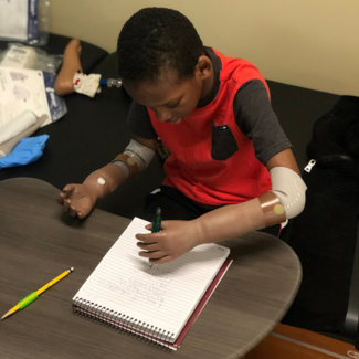 pediatric bilateral arm prosthetic